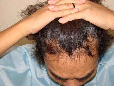 現在の藤田の頭皮。これでもう、“小さいアフロの人”とは言わせない!? (c)K-BO-BO-プロジェクト