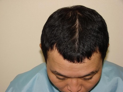現在のせいじの頭皮。オフィシャルサイトのインタビューで「俺には（髪を増やす）才能がある」と言うだけあり、非常に頼もしい結果となった。 (c)K-BO-BO-プロジェクト
