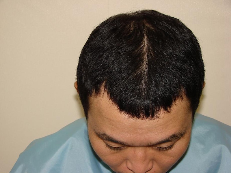 現在のせいじの頭皮。オフィシャルサイトのインタビューで「俺には（髪を増やす）才能がある」と言うだけあり、非常に頼もしい結果となった。 (c)K-BO-BO-プロジェクト