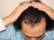 プロジェクト開始時の藤田の頭皮。先日も罰ゲームで緑のアフロにされるなど、職業柄常に髪へのダメージを受けやすい環境にある。 (c)K-BO-BO-プロジェクト