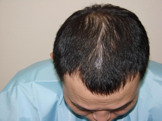 プロジェクト開始時のせいじの頭皮。8年前ルミネtheよしもとのオープンイベントのとき、華々しくツイストパーマを当てていた面影はまったくない。 (c)K-BO-BO-プロジェクト