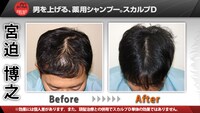 雨上がり決死隊宮迫の頭皮Before＆After。