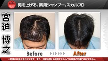 雨上がり決死隊宮迫の頭皮Before＆After。