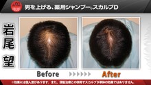 フットボールアワー岩尾の頭皮Before＆After。