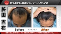 トータルテンボス藤田の頭皮Before＆After。