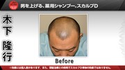 TKO木下のの頭皮Before＆After。芸人仲間からは“ハゲダルマ”と呼ばれることもあるそう。