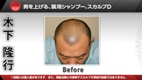 TKO木下のの頭皮Before＆After。芸人仲間からは“ハゲダルマ”と呼ばれることもあるそう。