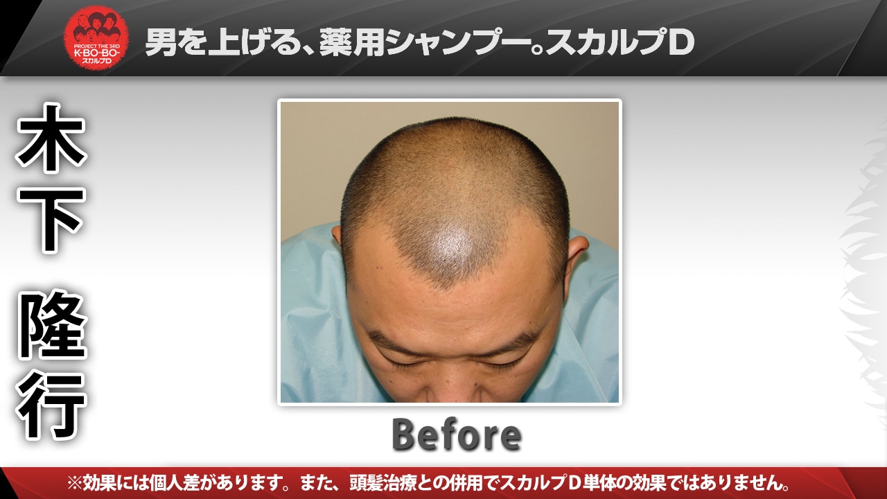 TKO木下のの頭皮Before＆After。芸人仲間からは“ハゲダルマ”と呼ばれることもあるそう。
