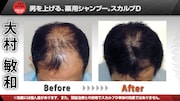 トータルテンボス大村の父親である大村敏和氏の頭皮Before＆After。