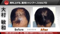 トータルテンボス大村の父親である大村敏和氏の頭皮Before＆After。