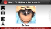 アームストロング栗山の頭皮Before。