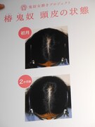 「薬用スカルプD ボーテ」使用前と使用2カ月後の頭皮の写真。