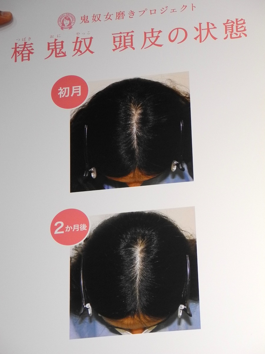 「薬用スカルプD ボーテ」使用前と使用2カ月後の頭皮の写真。